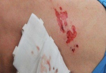 狂犬病为什么怕水？狂犬病的症状是什么？