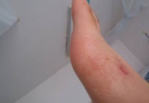 湿疹可以吃鱼吗？