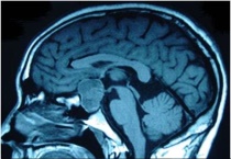 松果体囊肿常见吗？