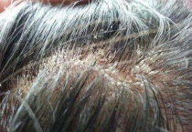 剪头虫是什么怎么治